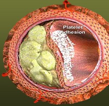 Can you reduce plaque in your arteries?