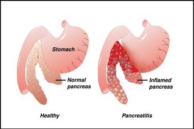 What are the symptoms of a failing pancreas?