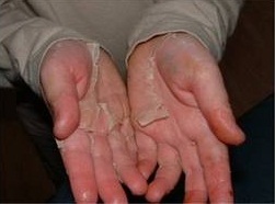 Why is my skin peeling off from my palm? - Quora