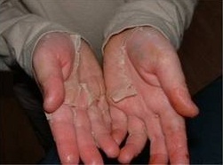 What Causes Peeling In Hands How To Help Med Health Net