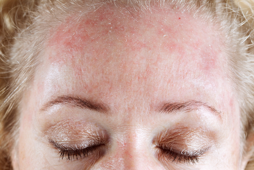 Reactions to Hair Dye - Allergy UK