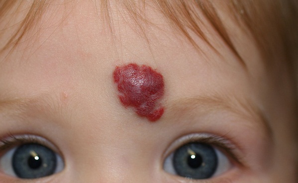 nevus birthmarks