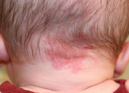 Online Dermatology - Strawberry marks (Hemangioma)