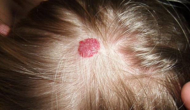 what causes strawberry moles - Top Doctor Insights on ...