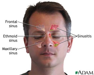 What causes pressure in the forehead area?