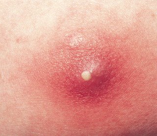 Herpes only on butt cheek - Herpes - MedHelp