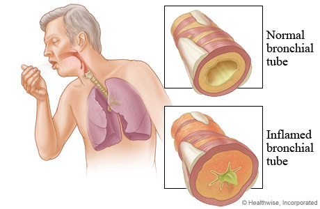 Coughing Up White Mucus | Med-Health.net