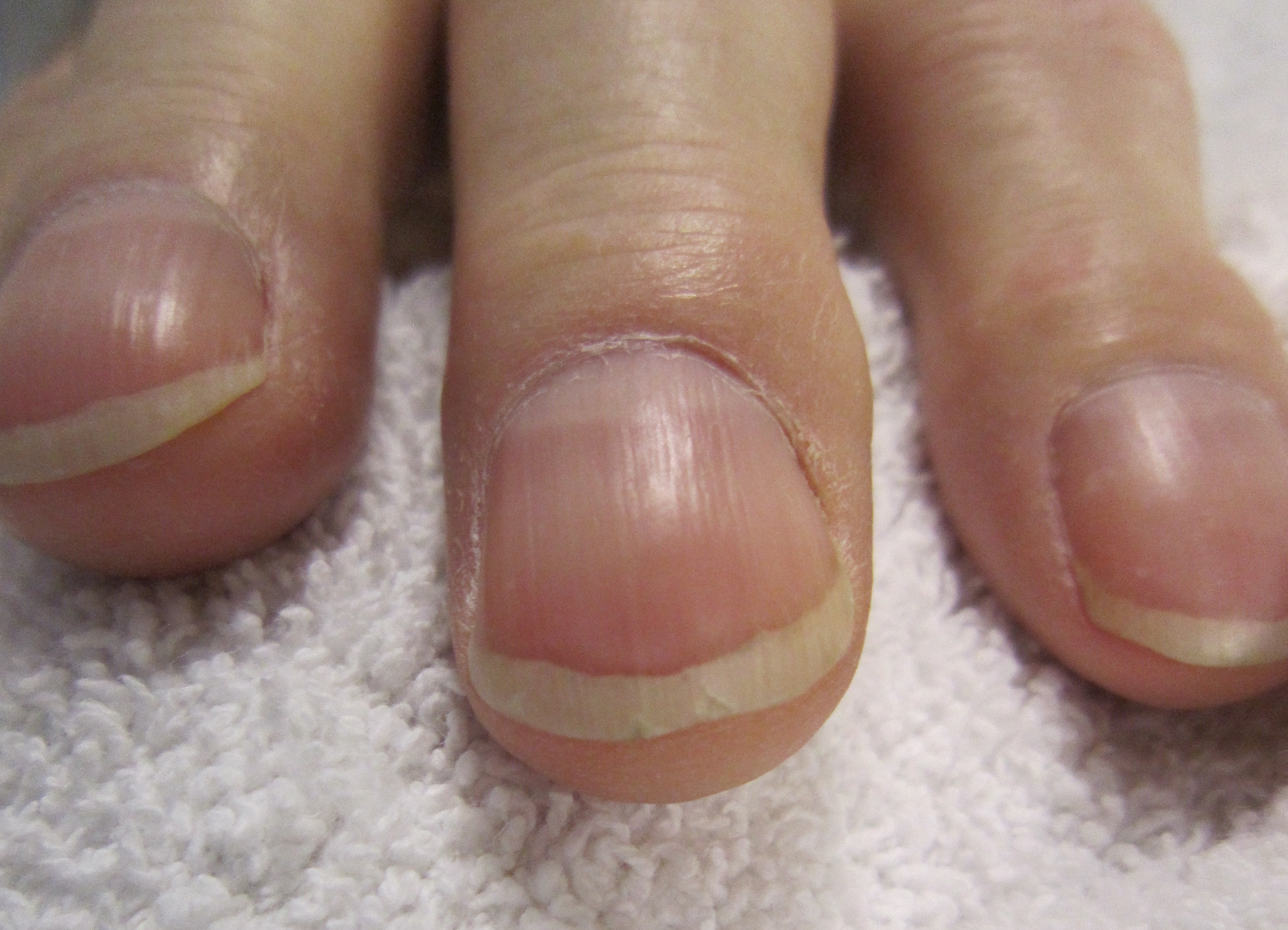 How to Treat Lifted Toenails | LIVESTRONG.COM