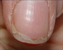 nail cracked nails health med splitting disorders causes