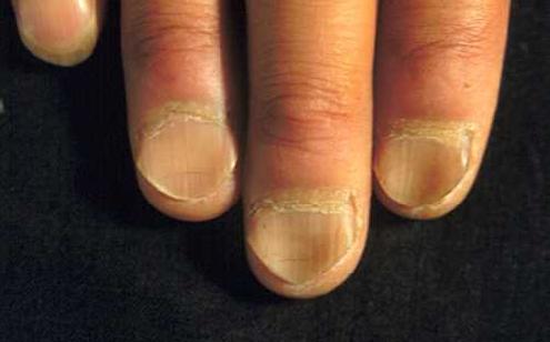 Nail Disorders Med Health
