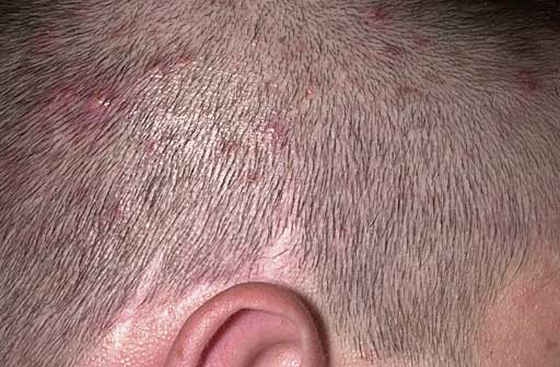 What causes scalp sores?