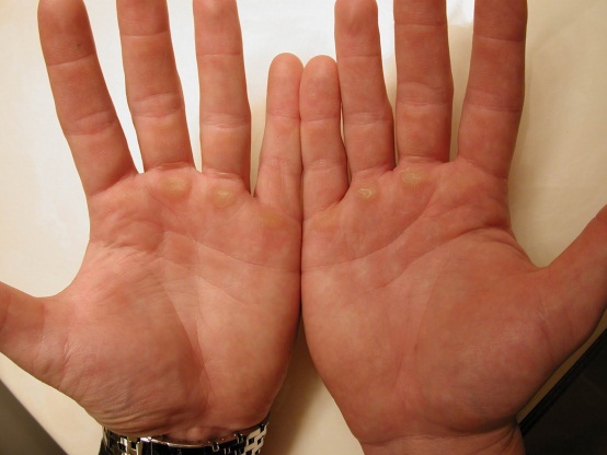 What are the possible causes of a lump in the hand?