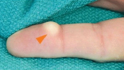 What are some causes of a lump in your wrist below your thumb?