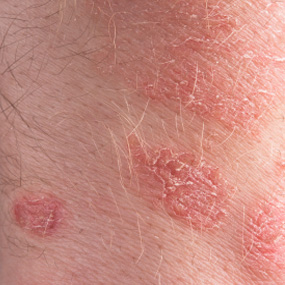 Skin Rash: 59 Pictures, Causes, Treatments - Healthline