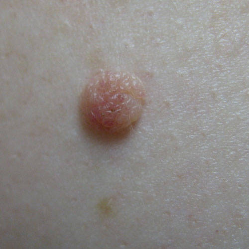 Melanocytic nevus - Wikipedia