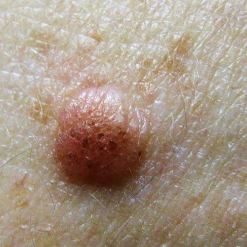 Melanoma | Pictures of abnormal moles | Cancer Research UK