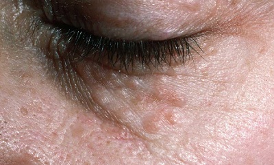 Rash around the Eyes: Causes and Natural Treatments