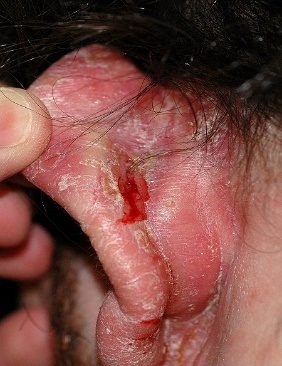 What are the possible causes of a rash behind the ears?