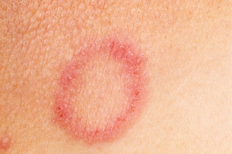 What Causes Red Blotches on Legs? | LIVESTRONG.COM