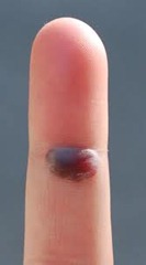 How does a popped blood vessel in the hand occur?