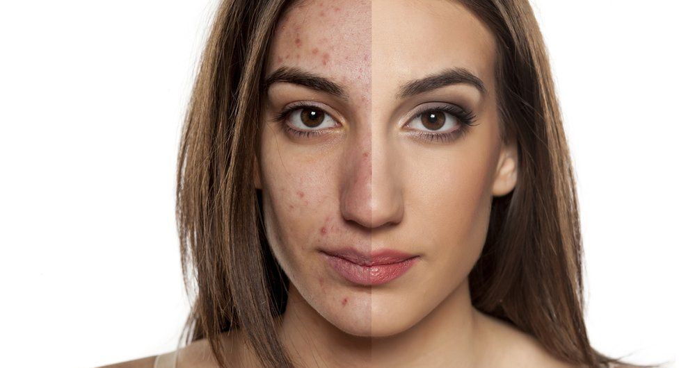 Can Gluten Cause Acne How To Deal With It Med Health can-gluten-cause-acne-how-to-deal-with-it-med-health